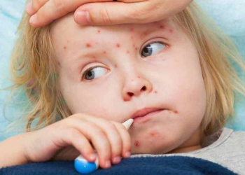 “Qızılca ilə bağlı durum epidemiyanın başlanğıcı hesab edilə bilər” - Pediatrlardan peyvənd çağırışı