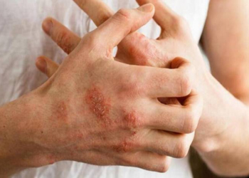 İnsanda allergiya necə yaranır?